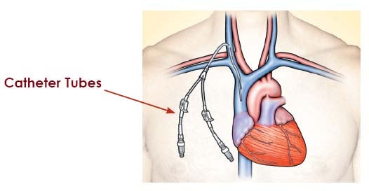 Catheter