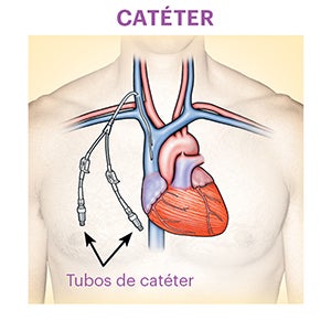 Catheter representation showing a catheter (a thin, flexible tube) connected to a a large vein in the neck/chest region, and two Catheter Tubes available for connection as a result