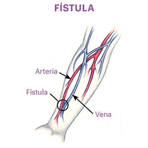 Fistula representation showing the connection of an artery in a forearm to a nearby vein to create an access site.
