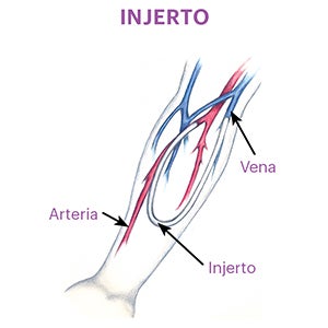 Graft representation showing the connection of an artery and a nearby vein with a small tube to create an access site.