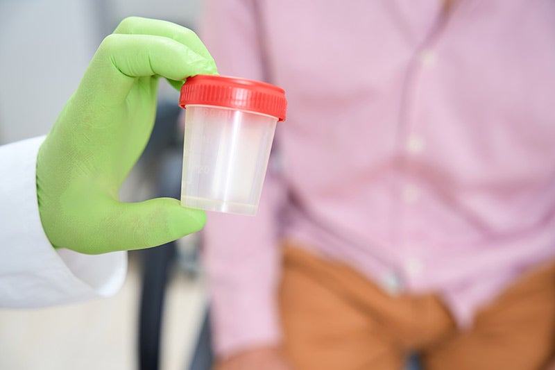 urine sample cup used for kidney testing