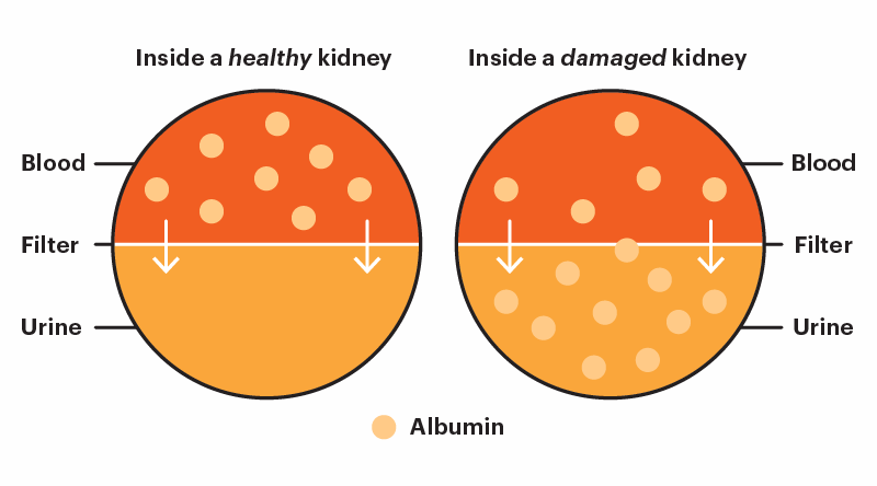 Healthy Kidney vs Damaged Kidney Filtration Image