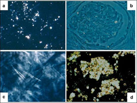 Cystine Crystals in Tissues of Nephropathic Cystinotic Patients