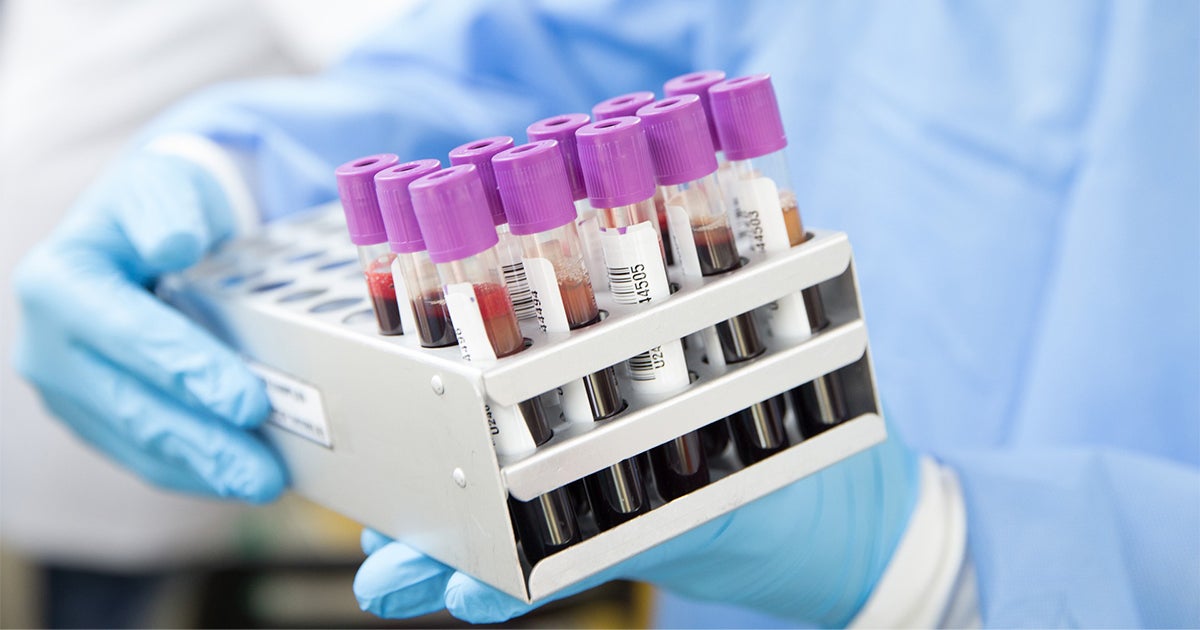 Patient Perspectives On Managing Routine Blood Tests During COVID 19 