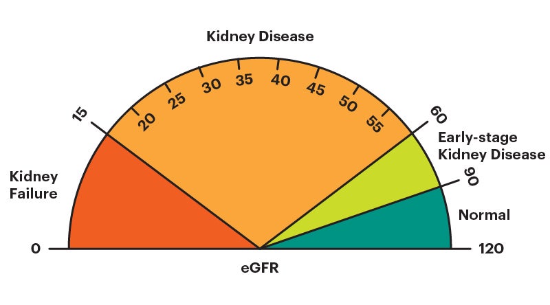 A pie chart graphic of a speedometer-like dial that depicts GFR results of 0 to 15 as kidney failure, 15 to 60 as kidney disease, 60 to 90 as early-stage kidney disease, and 90 to 120 as normal