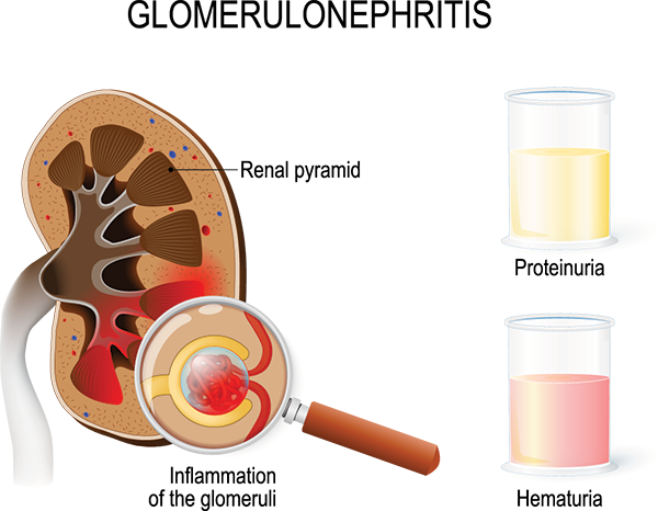 glomerulonephritis diagram