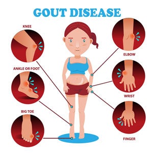 gout disease