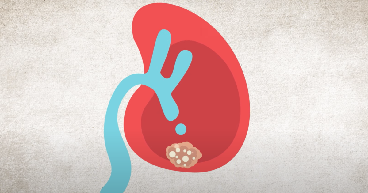 Kidney Disease Heat Map