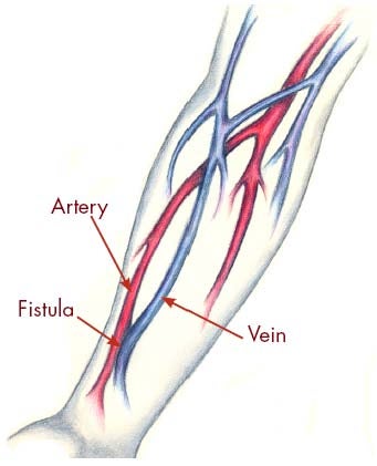 Fistula Formation For Renal Dialysis Diet