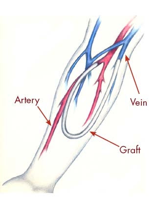 Fistula Formation For Renal Dialysis Diet