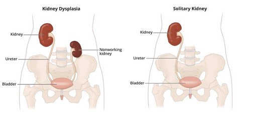 Kidney Dysplasia vs Solitary Kidney Image