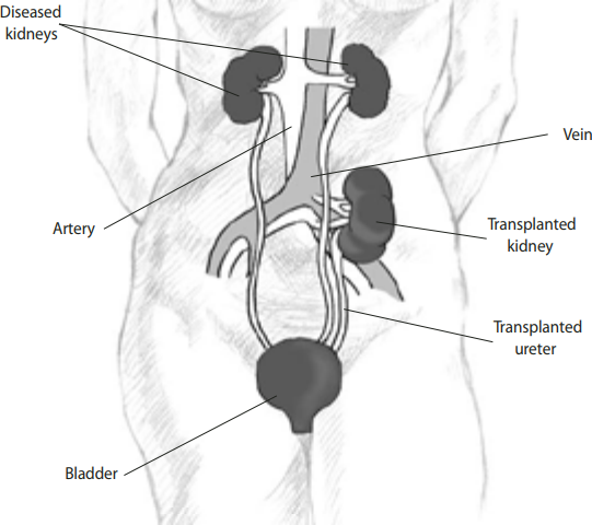 assignment on kidney transplant