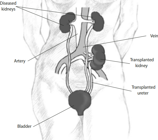 | National Kidney Foundation