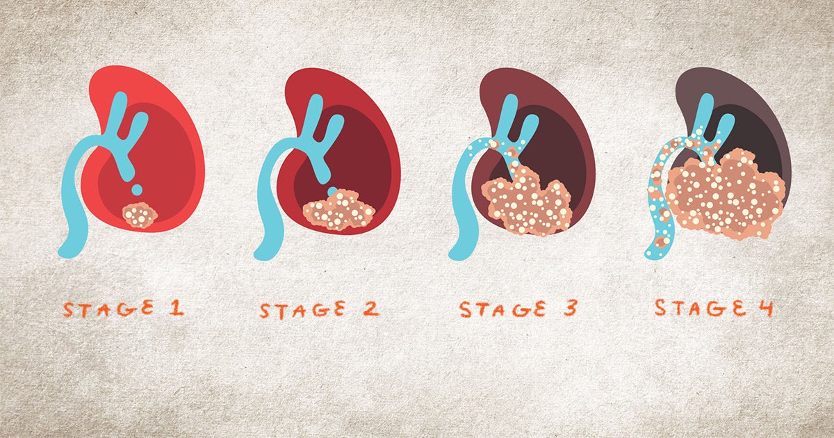 NKF Launches Educational Animated Video Series on Kidney Cancer | National Kidney Foundation NKF Launches Educational Animated Video Series on Kidney Cancer | National Kidney Foundation