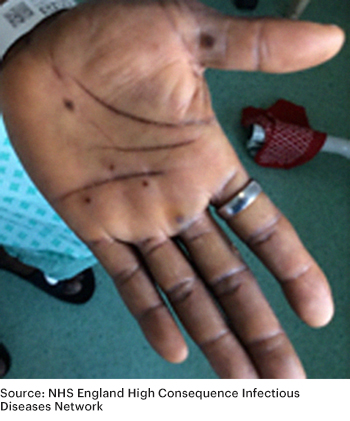 Ejemplo visual de erupción de viruela símica en la palma de una mano. Fuente: NHS England High Consequence Infectious Disease Network