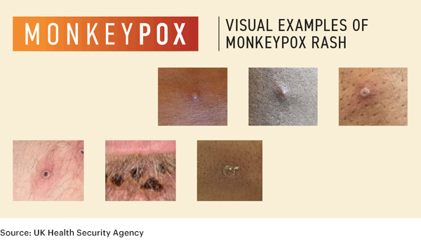 Source: UK Health Security Agency. Pictures showing examples of rashes and lesions caused by the monkeypox virus are seen in this undated handout image.
