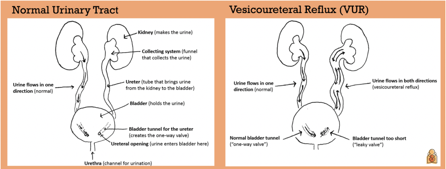 normal vs. Visicoureteral Reflux (VUR) kidney