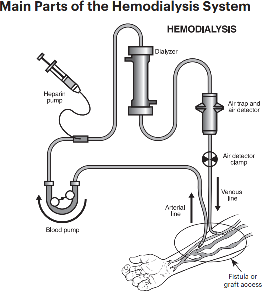 what-is-hemodialysis-national-kidney-foundation