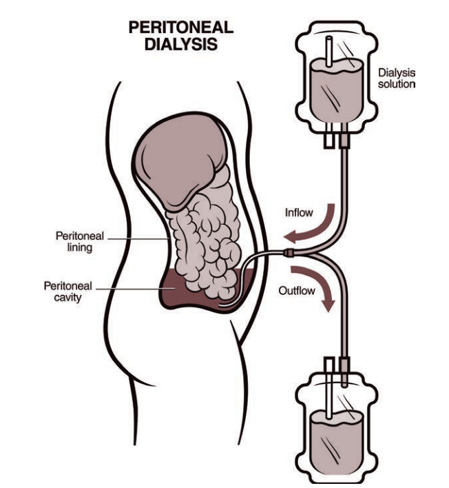  What Is Peritoneal Dialysis National Kidney Foundation