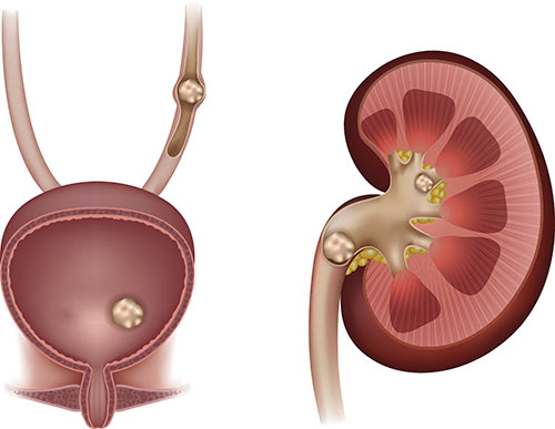 stones in the kidney urinary bladder