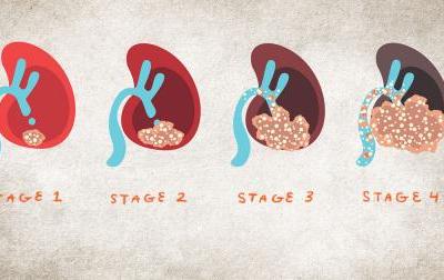 Kidney Cancer Scanning Image