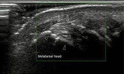 ultrasound-detected erosions of gout in the first MTP joint
